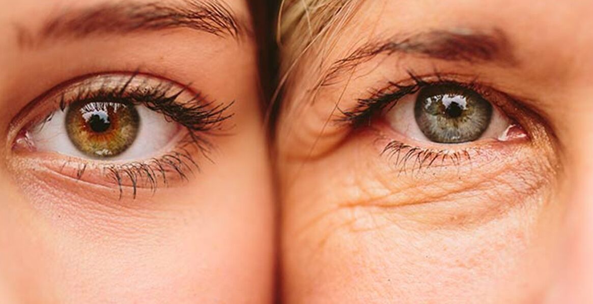 סימנים חיצוניים להזדקנות העור סביב העיניים אצל שתי נשים בגילאים שונים