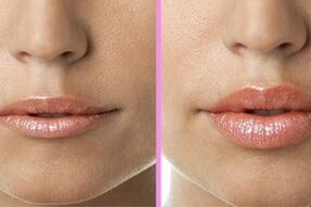 לפני ואחרי הליך שחזור השפתיים